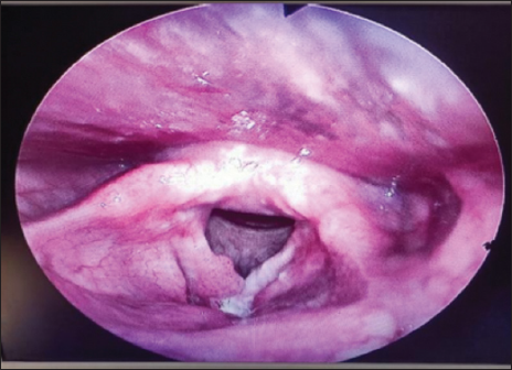 Proliferative growth right vocal cord.